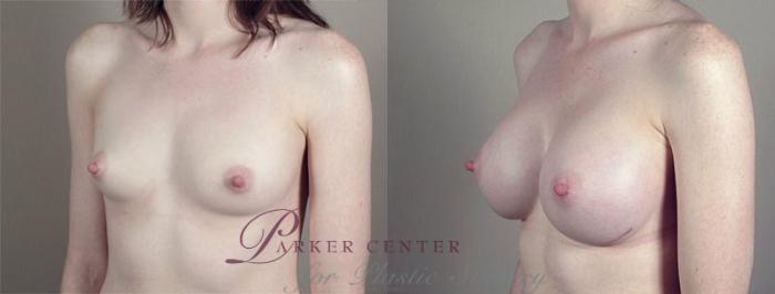 Breast Augmentation Case 420 Before & After View #2 | Paramus, NJ | Parker Center for Plastic Surgery