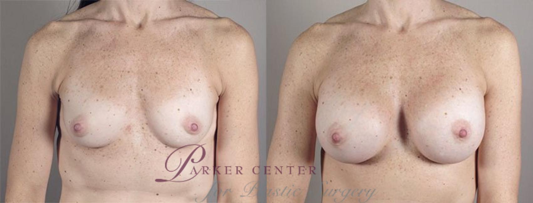 Breast Augmentation Case 421 Before & After View #1 | Paramus, NJ | Parker Center for Plastic Surgery