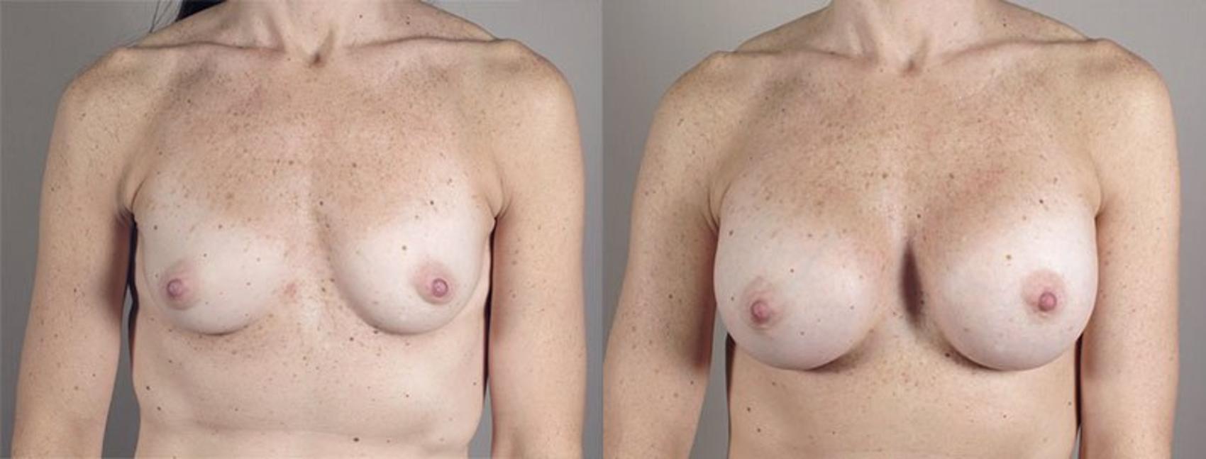 Breast Augmentation Case 421 Before & After View #1 | Paramus, NJ | Parker Center for Plastic Surgery