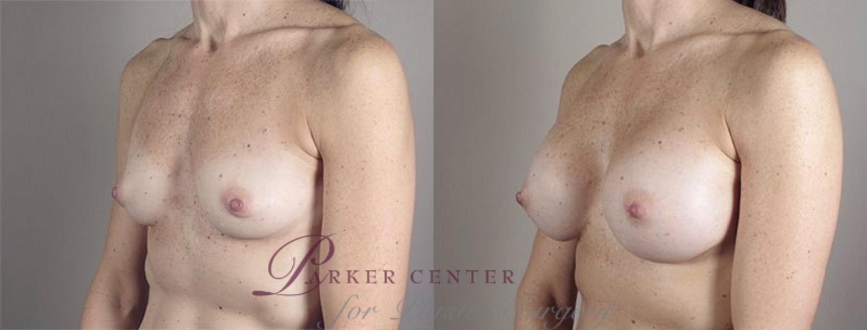 Breast Augmentation Case 421 Before & After View #2 | Paramus, NJ | Parker Center for Plastic Surgery