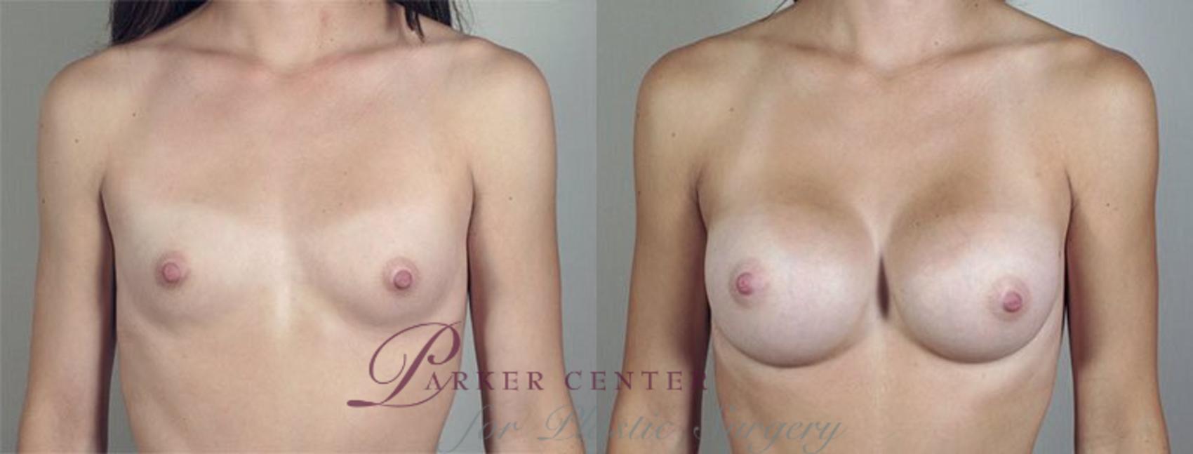 Breast Augmentation Case 422 Before & After View #1 | Paramus, NJ | Parker Center for Plastic Surgery