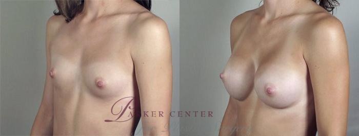 Breast Augmentation Case 422 Before & After View #2 | Paramus, NJ | Parker Center for Plastic Surgery