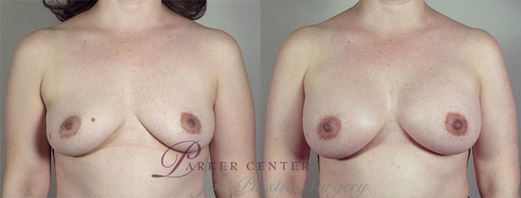 Breast Augmentation Case 423 Before & After View #1 | Paramus, NJ | Parker Center for Plastic Surgery