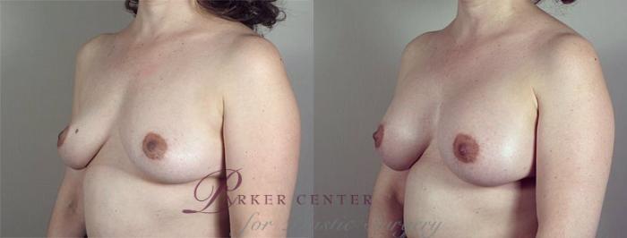 Breast Augmentation Case 423 Before & After View #2 | Paramus, NJ | Parker Center for Plastic Surgery