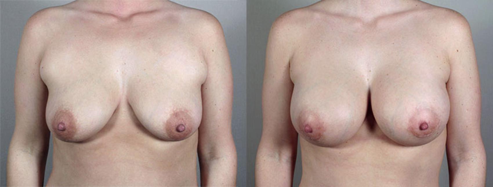 Breast Implant Revision Case 424 Before & After View #1 | Paramus, NJ | Parker Center for Plastic Surgery