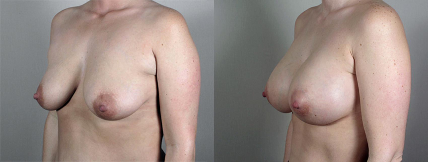 Breast Augmentation Case 424 Before & After View #2 | Paramus, NJ | Parker Center for Plastic Surgery