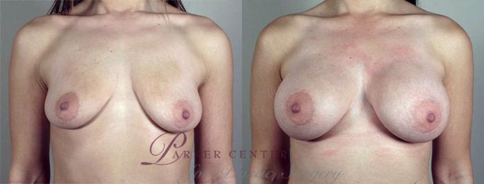 Breast Augmentation Case 425 Before & After View #1 | Paramus, NJ | Parker Center for Plastic Surgery