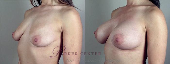 Breast Augmentation Case 425 Before & After View #2 | Paramus, NJ | Parker Center for Plastic Surgery