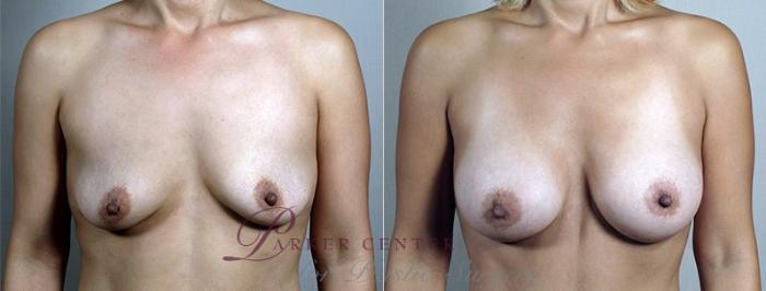 Breast Augmentation Case 427 Before & After View #1 | Paramus, NJ | Parker Center for Plastic Surgery