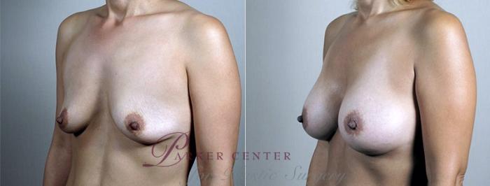 Breast Augmentation Case 427 Before & After View #2 | Paramus, NJ | Parker Center for Plastic Surgery