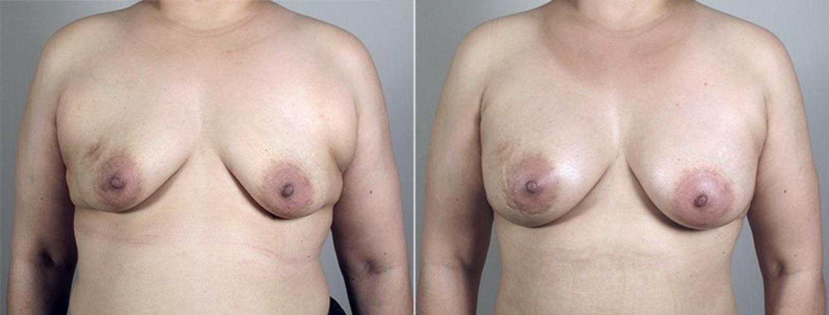 Breast Augmentation Case 428 Before & After View #1 | Paramus, New Jersey | Parker Center for Plastic Surgery