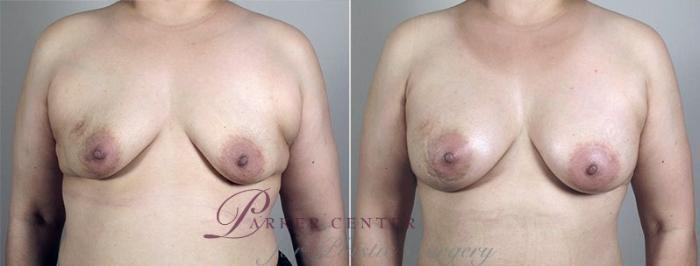 Breast Augmentation Case 428 Before & After View #1 | Paramus, NJ | Parker Center for Plastic Surgery