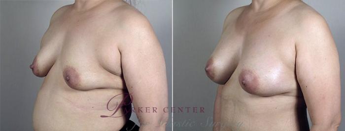 Breast Augmentation Case 428 Before & After View #2 | Paramus, NJ | Parker Center for Plastic Surgery