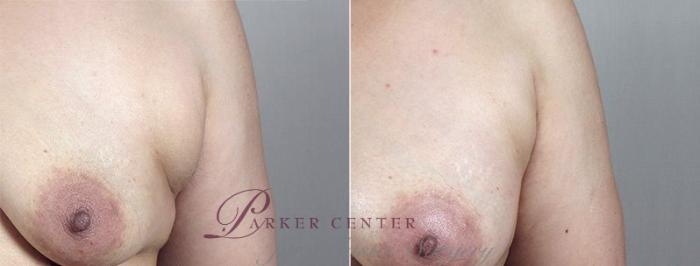Breast Augmentation Case 428 Before & After View #3 | Paramus, NJ | Parker Center for Plastic Surgery