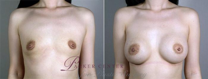 Breast Augmentation Case 430 Before & After View #1 | Paramus, NJ | Parker Center for Plastic Surgery