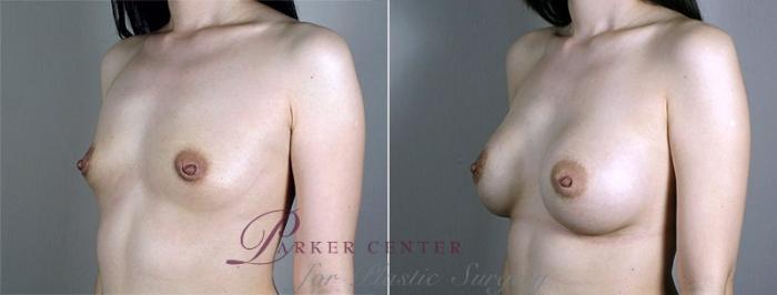 Breast Augmentation Case 430 Before & After View #2 | Paramus, NJ | Parker Center for Plastic Surgery