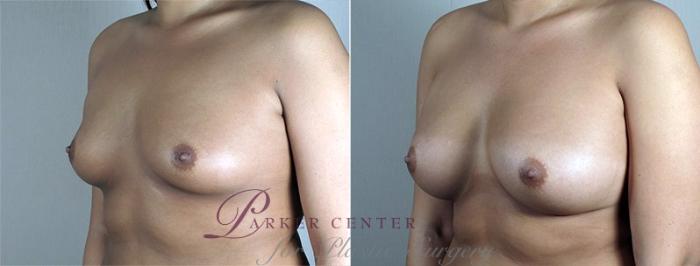 Breast Augmentation Case 431 Before & After View #1 | Paramus, NJ | Parker Center for Plastic Surgery