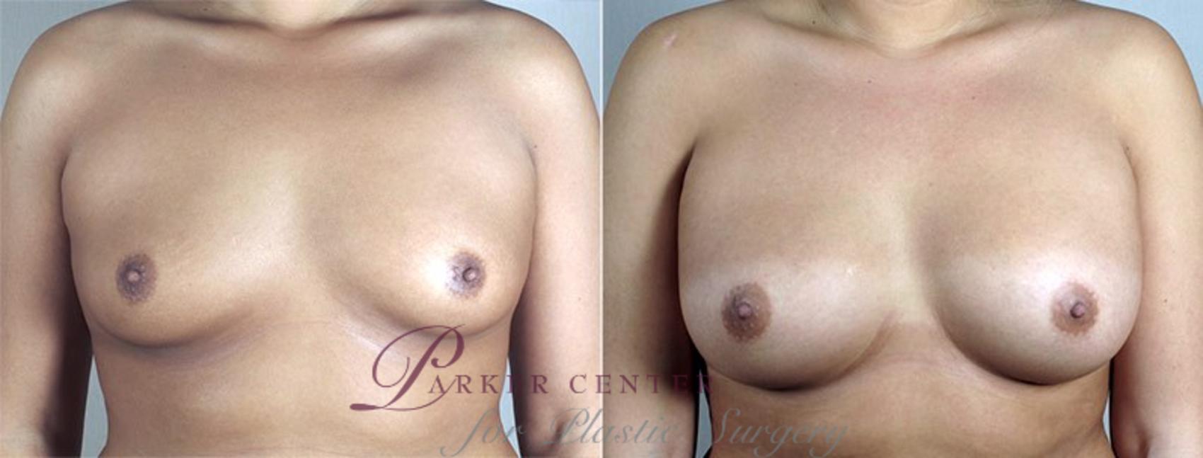 Breast Augmentation Case 431 Before & After View #2 | Paramus, NJ | Parker Center for Plastic Surgery