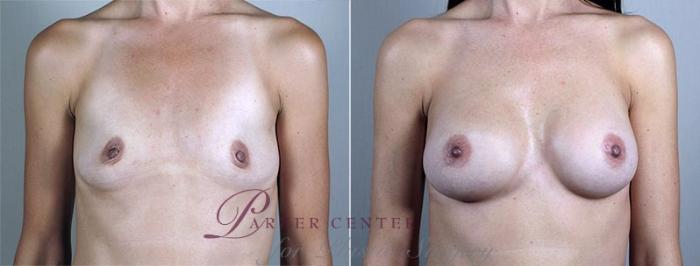 Breast Augmentation Case 432 Before & After View #1 | Paramus, NJ | Parker Center for Plastic Surgery