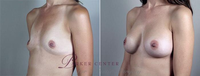 Breast Augmentation Case 432 Before & After View #2 | Paramus, NJ | Parker Center for Plastic Surgery