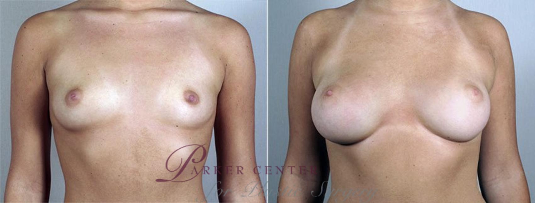Breast Augmentation Case 433 Before & After View #1 | Paramus, NJ | Parker Center for Plastic Surgery