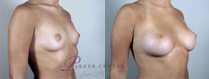 Breast Augmentation Case 433 Before & After View #2 | Paramus, NJ | Parker Center for Plastic Surgery