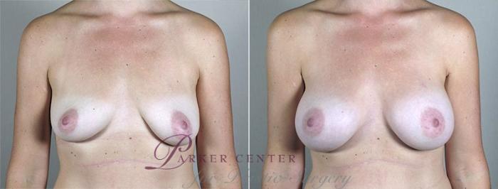Breast Augmentation Case 434 Before & After View #1 | Paramus, NJ | Parker Center for Plastic Surgery
