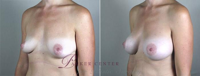 Breast Augmentation Case 434 Before & After View #2 | Paramus, NJ | Parker Center for Plastic Surgery