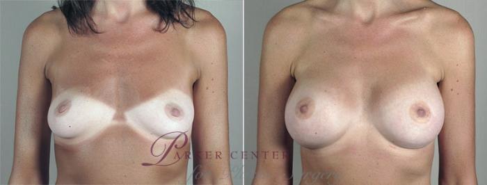 Breast Augmentation Case 435 Before & After View #1 | Paramus, NJ | Parker Center for Plastic Surgery