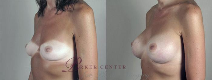 Breast Augmentation Case 435 Before & After View #2 | Paramus, NJ | Parker Center for Plastic Surgery