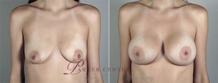 Breast Augmentation Case 436 Before & After View #1 | Paramus, NJ | Parker Center for Plastic Surgery