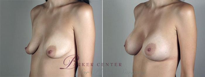 Breast Augmentation Case 436 Before & After View #2 | Paramus, NJ | Parker Center for Plastic Surgery