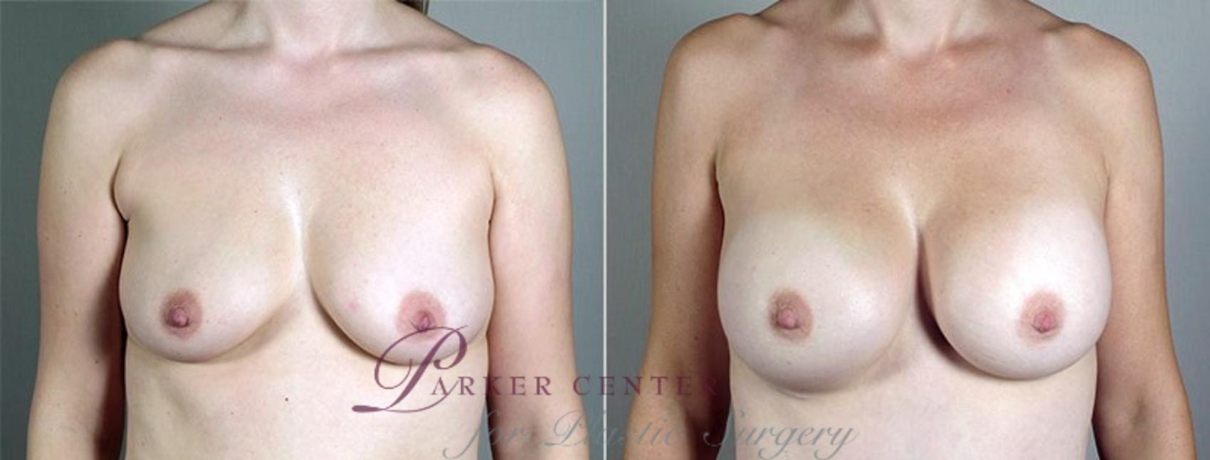 Breast Augmentation Case 438 Before & After View #1 | Paramus, NJ | Parker Center for Plastic Surgery