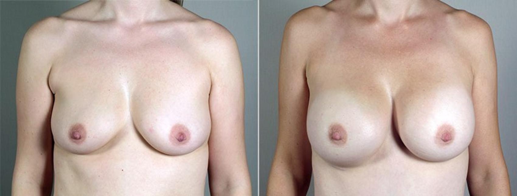 Breast Augmentation Case 438 Before & After View #1 | Paramus, NJ | Parker Center for Plastic Surgery