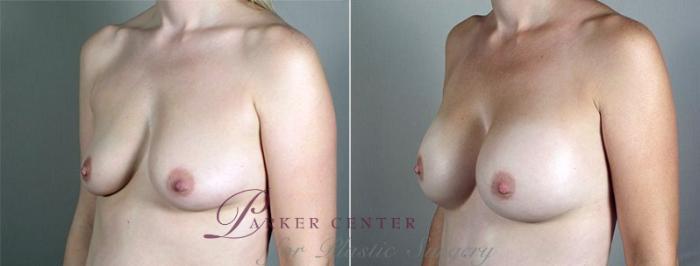Breast Augmentation Case 438 Before & After View #2 | Paramus, NJ | Parker Center for Plastic Surgery