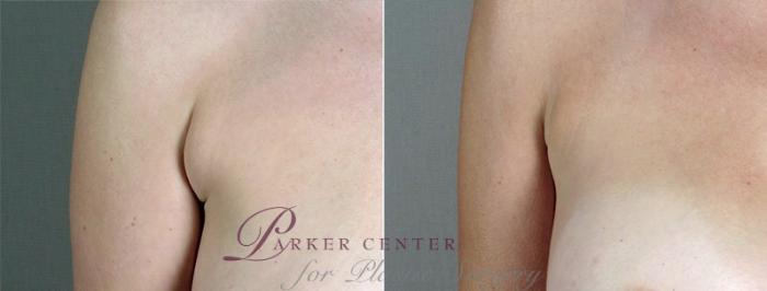 Breast Augmentation Case 438 Before & After View #3 | Paramus, NJ | Parker Center for Plastic Surgery