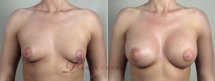 Breast Augmentation Case 439 Before & After View #1 | Paramus, NJ | Parker Center for Plastic Surgery