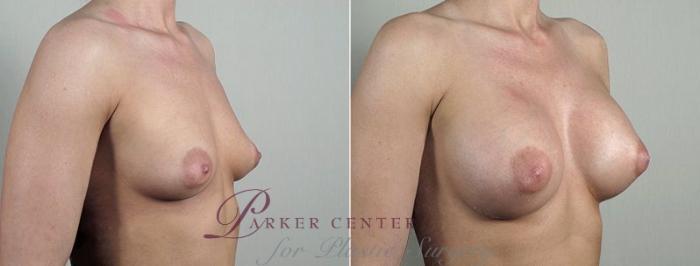 Breast Augmentation Case 439 Before & After View #2 | Paramus, NJ | Parker Center for Plastic Surgery