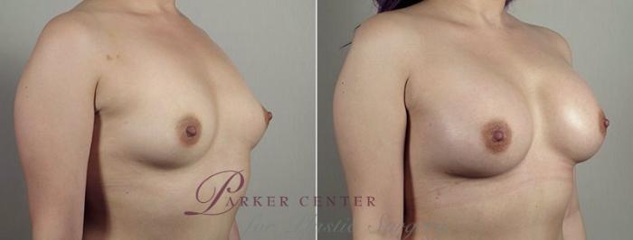 Breast Augmentation Case 441 Before & After View #1 | Paramus, NJ | Parker Center for Plastic Surgery