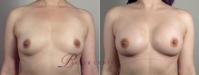 Breast Augmentation Case 441 Before & After View #2 | Paramus, NJ | Parker Center for Plastic Surgery