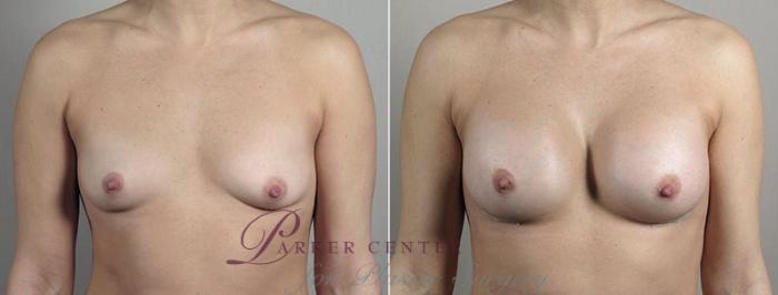 Breast Augmentation Case 442 Before & After View #1 | Paramus, NJ | Parker Center for Plastic Surgery
