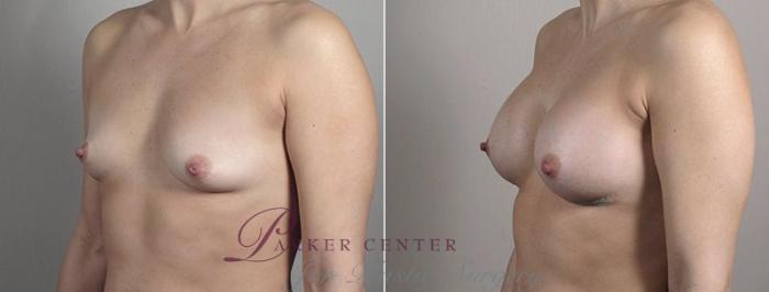 Breast Augmentation Case 442 Before & After View #2 | Paramus, NJ | Parker Center for Plastic Surgery