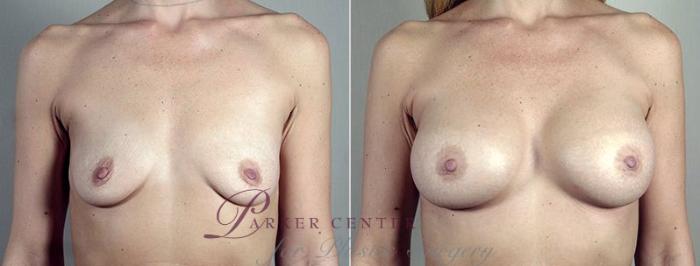 Breast Augmentation Case 444 Before & After View #1 | Paramus, NJ | Parker Center for Plastic Surgery