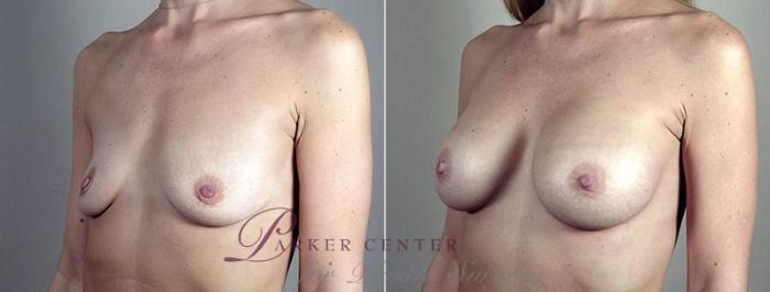 Breast Augmentation Case 444 Before & After View #2 | Paramus, NJ | Parker Center for Plastic Surgery