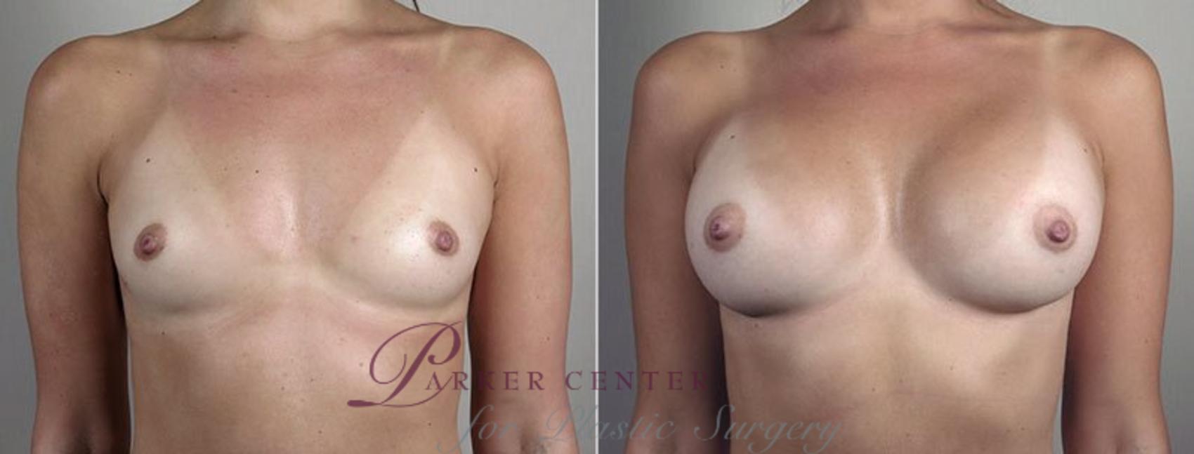 Breast Augmentation Case 445 Before & After View #1 | Paramus, NJ | Parker Center for Plastic Surgery