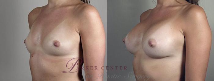 Breast Augmentation Case 445 Before & After View #2 | Paramus, NJ | Parker Center for Plastic Surgery
