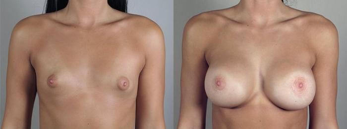 Breast Augmentation Case 475 Before & After View #1 | Paramus, New Jersey | Parker Center for Plastic Surgery