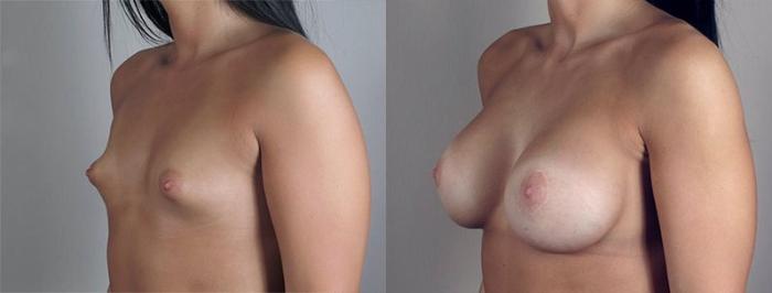 Breast Augmentation Case 475 Before & After View #2 | Paramus, New Jersey | Parker Center for Plastic Surgery