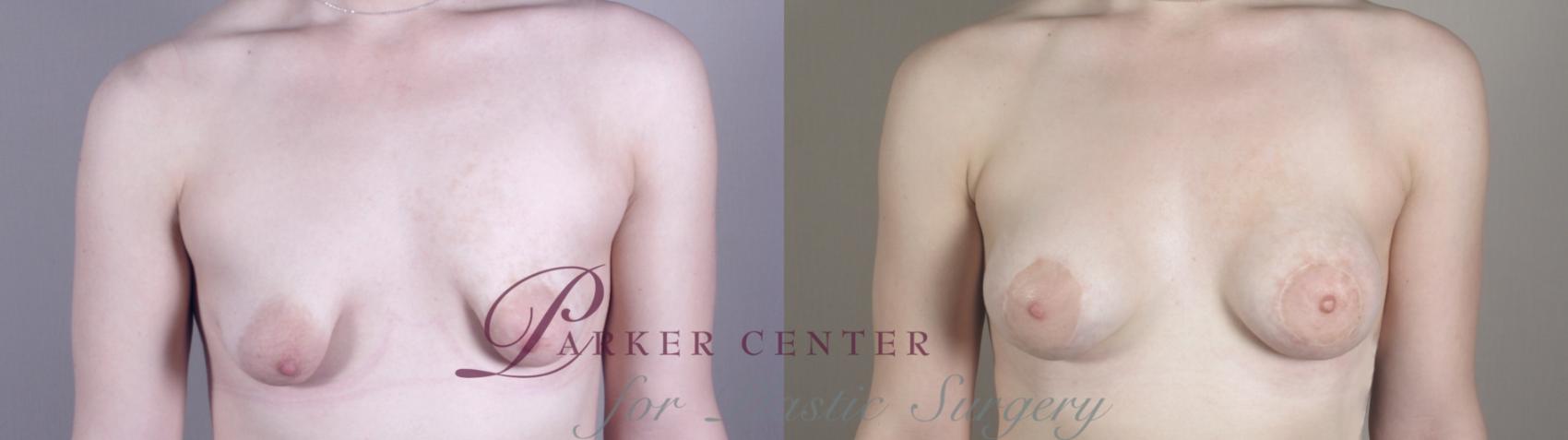 Breast Lift with Implants Case 971 Before & After Front | Paramus, NJ | Parker Center for Plastic Surgery
