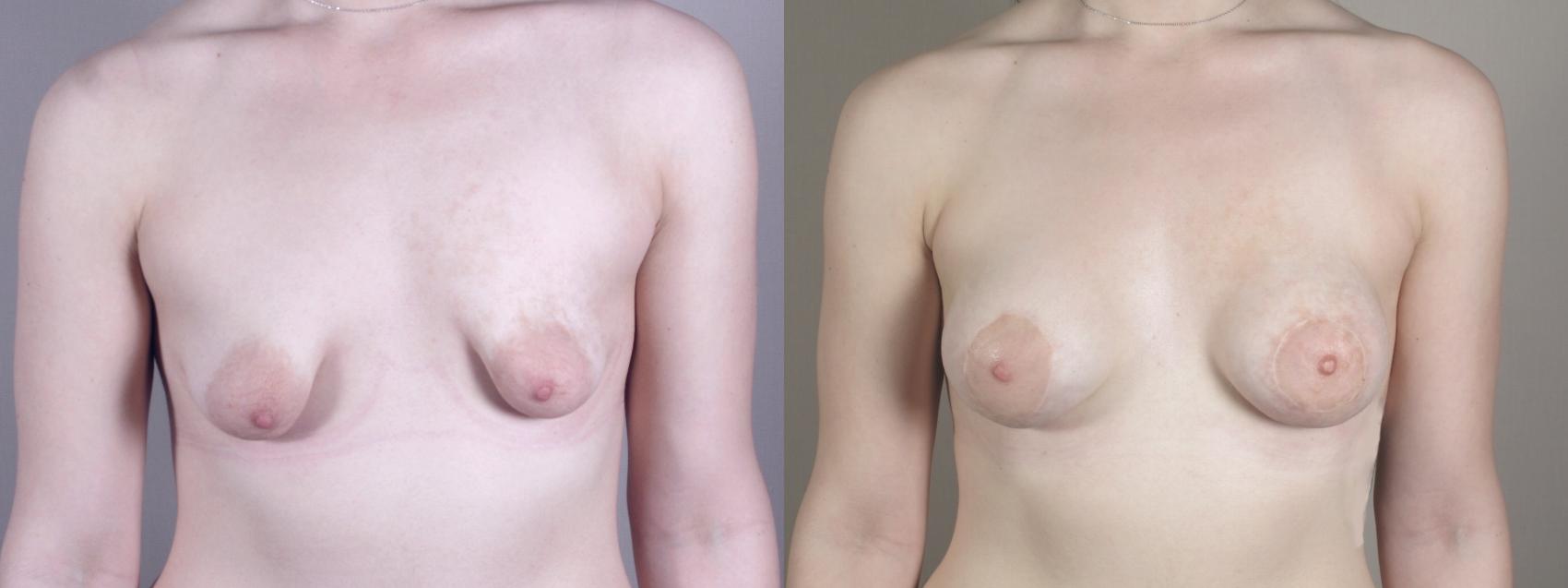 Breast Augmentation Case 971 Before & After Front | Paramus, NJ | Parker Center for Plastic Surgery